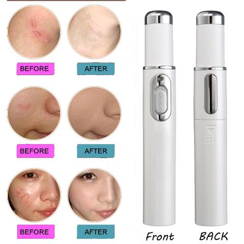 Blue Light Acne Treatment Pen – Skin Repair Device for Acne, Scars & Wrinkles